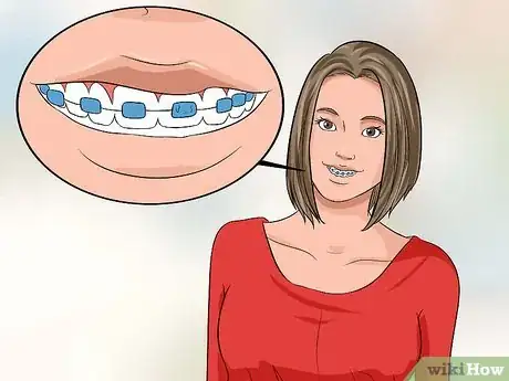 Imagen titulada Choose the Color of Your Braces Step 4