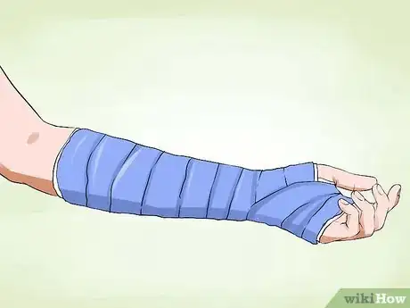 Imagen titulada Manage a Broken Arm Step 7