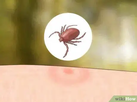 Imagen titulada Identify Insect Bites Step 5