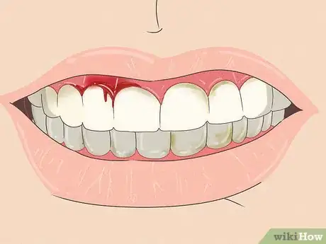 Imagen titulada Tell if Someone Is Bulimic Step 5