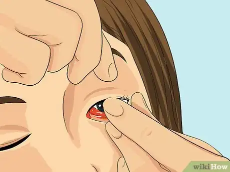 Imagen titulada Put In and Take Out Contacts Step 11
