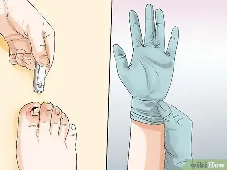 Imagen titulada Prevent the Spread of Fungal Infections Step 13