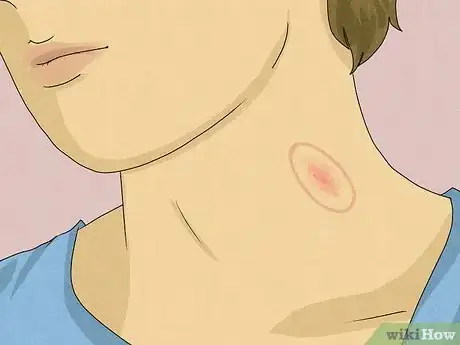 Imagen titulada Identify a Hickey Step 2