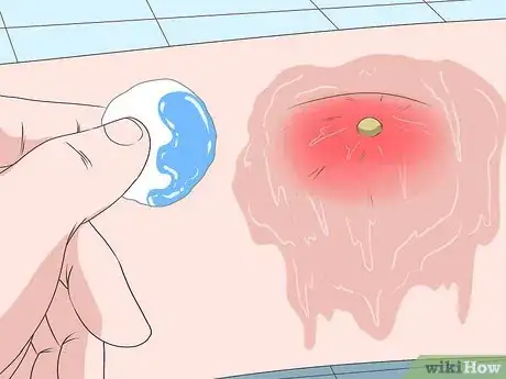 Imagen titulada Remove Pus from a Wound Step 4