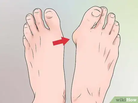 Imagen titulada Treat a Corn or Callus Step 13
