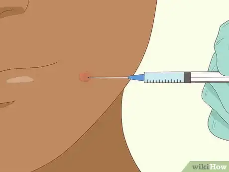 Imagen titulada Avoid Blind Pimples Step 10