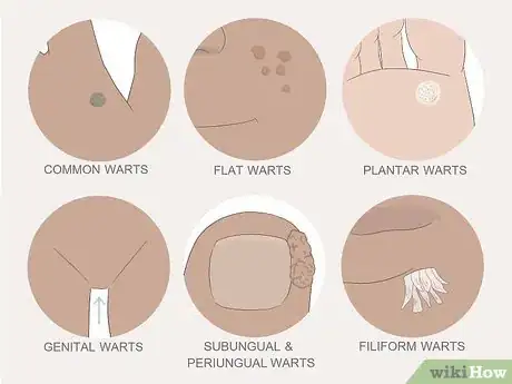 Imagen titulada Get Rid of Warts Step 37