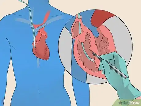Imagen titulada Treat Tachycardia Step 8