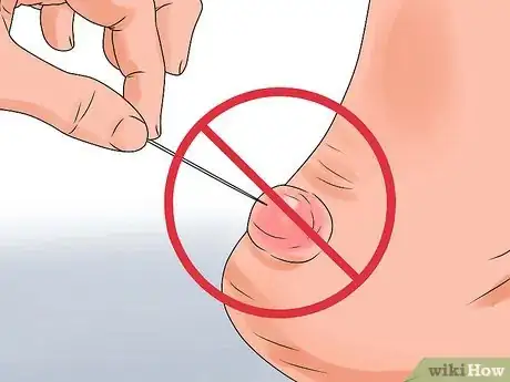 Imagen titulada Heal Blisters Step 1