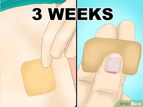Imagen titulada Use a Contraceptive Patch Step 12