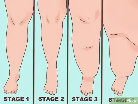 Imagen titulada Diagnose Lipedema Step 2