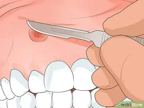 Imagen titulada Get Rid of a Gum Boil Step 1