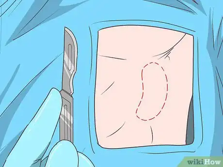 Imagen titulada Treat an Enlarged Spleen Step 9