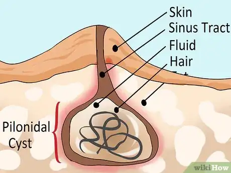 Imagen titulada Treat a Pilonidal Cyst Step 10