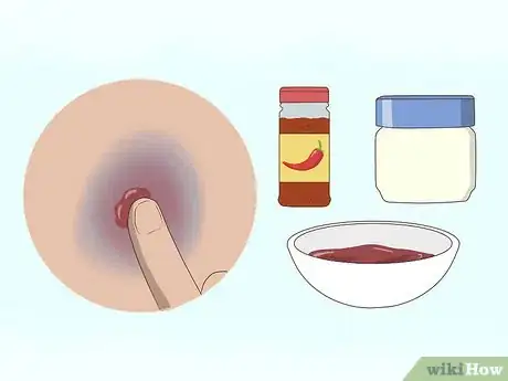 Imagen titulada Make a Bruise Go Away Faster Step 13