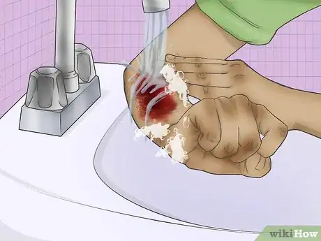 Imagen titulada Treat a Turf Burn Step 1
