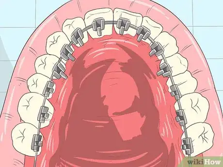 Imagen titulada Straighten Your Teeth Without Braces Step 12