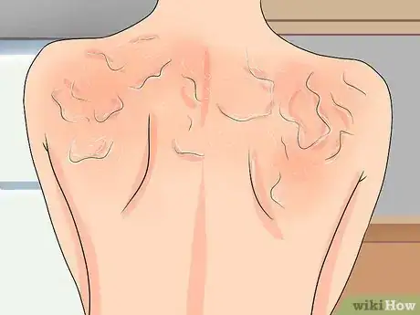 Imagen titulada Treat a Blistered Sunburn Step 27