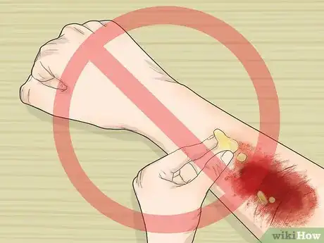 Imagen titulada Treat a Turf Burn Step 7