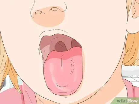 Imagen titulada Stop Tongue Bleeding Step 11
