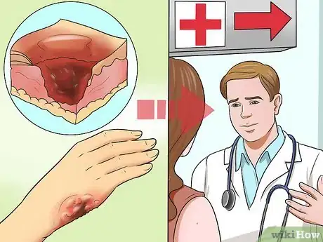 Imagen titulada Treat Minor Burns Step 4