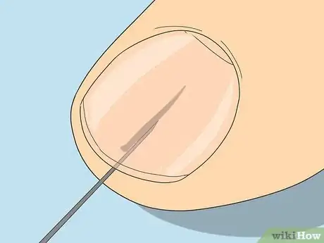 Imagen titulada Remove a Splinter Under Your Fingernail Step 4