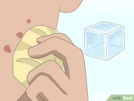 Imagen titulada Get Rid of Acne Scars Fast Step 15
