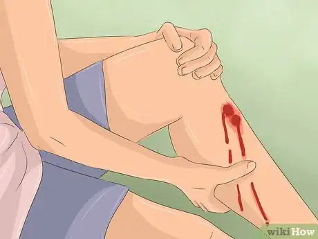Imagen titulada Treat a Rattlesnake Bite Step 6
