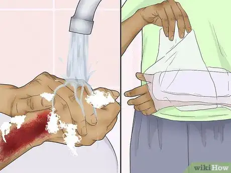 Imagen titulada Treat a Turf Burn Step 6