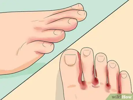 Imagen titulada Treat Athlete's Foot Step 2
