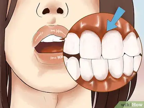 Imagen titulada Heal Mouth Inflammation Step 10