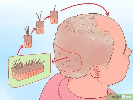 Imagen titulada Fix a Receding Hairline Step 6