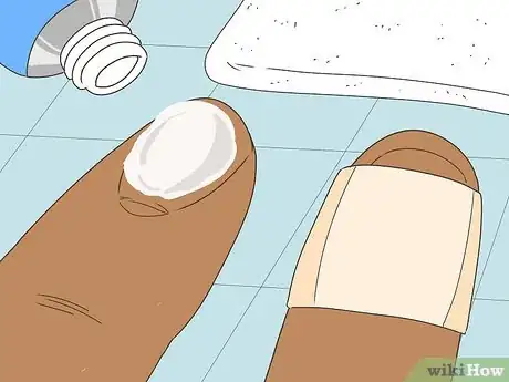 Imagen titulada Remove a Splinter Under Your Fingernail Step 5
