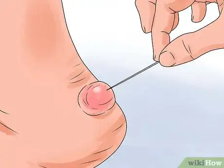 Imagen titulada Heal Blisters Step 12