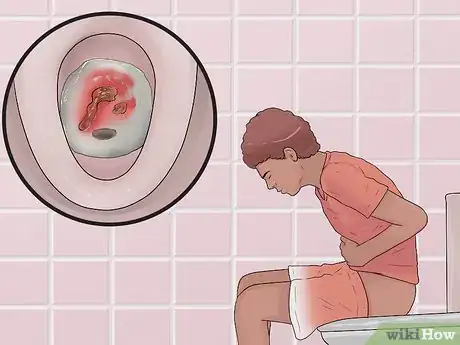 Imagen titulada Distinguish Ulcerative Colitis from Similar Conditions Step 1