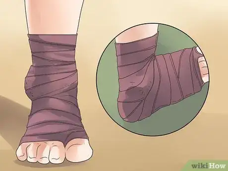 Imagen titulada Deal with Gout in Ankles with FSGS Step 4