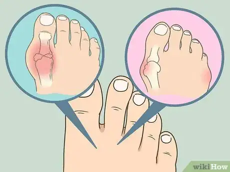 Imagen titulada Soak an Ingrown Toenail Step 10
