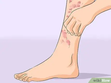 Imagen titulada Treat Cellulitis Step 2