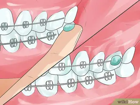 Imagen titulada Handle Poking Wires on Braces Step 4
