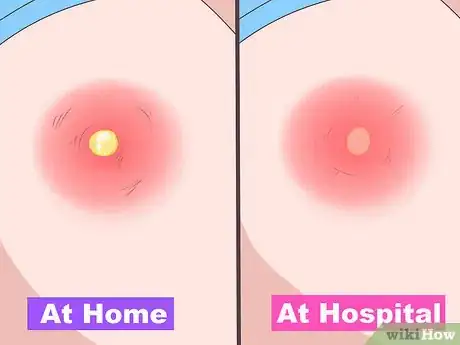 Imagen titulada Remove Pus from a Wound Step 2