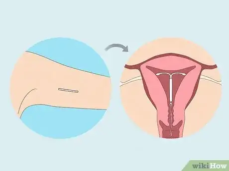 Imagen titulada Remove Nexplanon Step 3