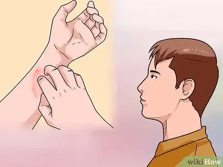 Imagen titulada Treat Hives Naturally Step 1