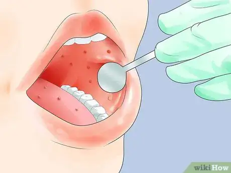 Imagen titulada Diagnose Measles Step 3