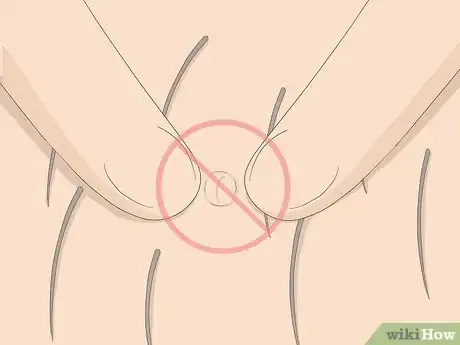 Imagen titulada Get Rid of Ingrown Pubic Hair Step 2