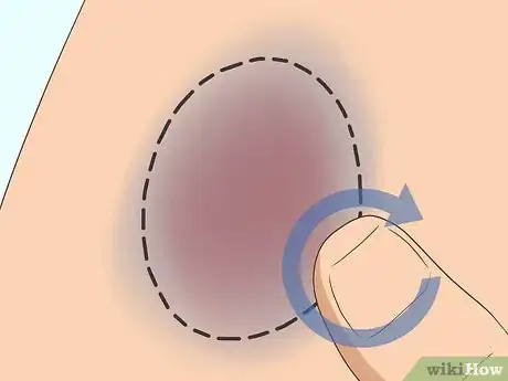 Imagen titulada Make a Bruise Go Away Faster Step 5