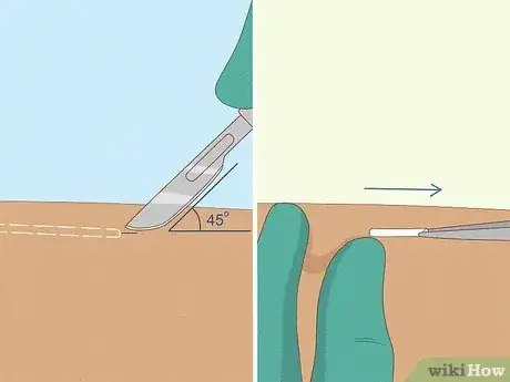 Imagen titulada Remove Nexplanon Step 8