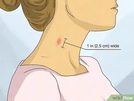 Imagen titulada Identify a Hickey Step 1