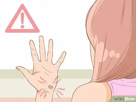 Imagen titulada Treat a Blood Blister Step 17