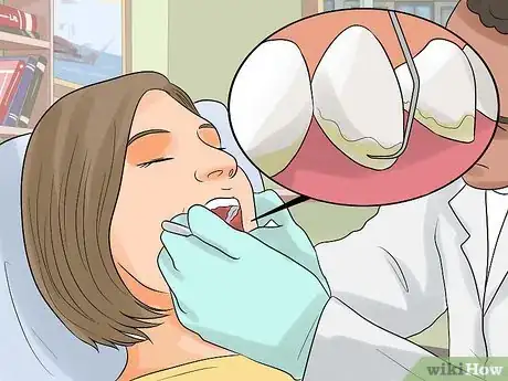 Imagen titulada Stop Itchy Gums Step 12