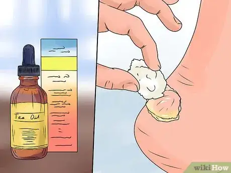 Imagen titulada Heal Blisters Step 7